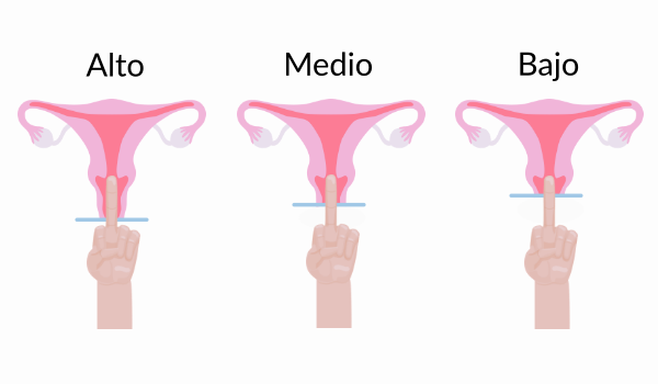 Tipos de cérvix o cuello uterino